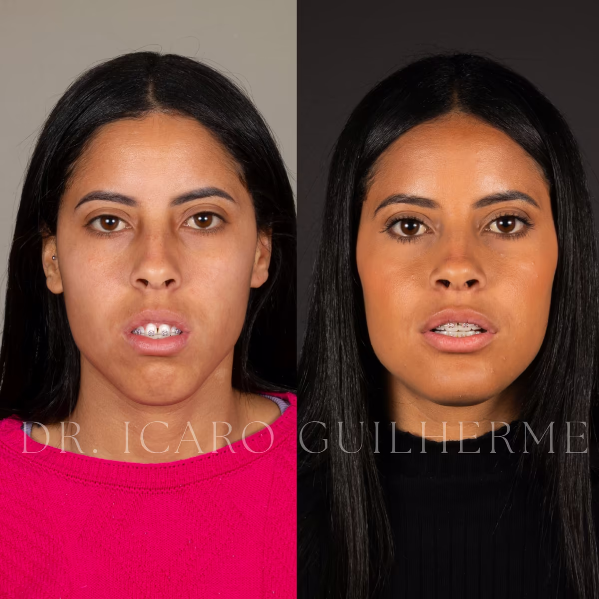 Antes e depois de correção de sorriso gengival — vista frontal em repouso, segundo caso