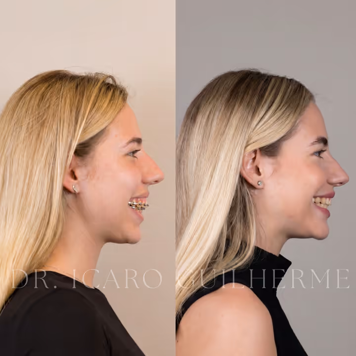 Antes e depois de correção de sorriso gengival — vista de perfil sorrindo
