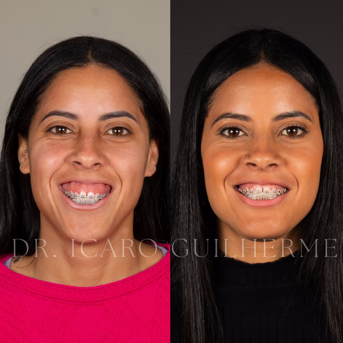 Antes e depois de correção de sorriso gengival — vista frontal sorrindo, segundo caso