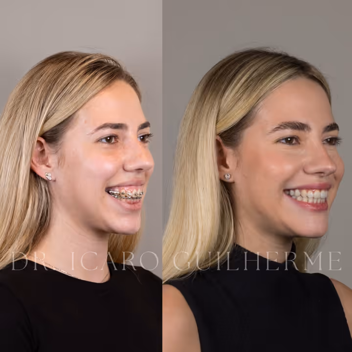 Antes e depois de correção de sorriso gengival — vista três-quartos sorrindo