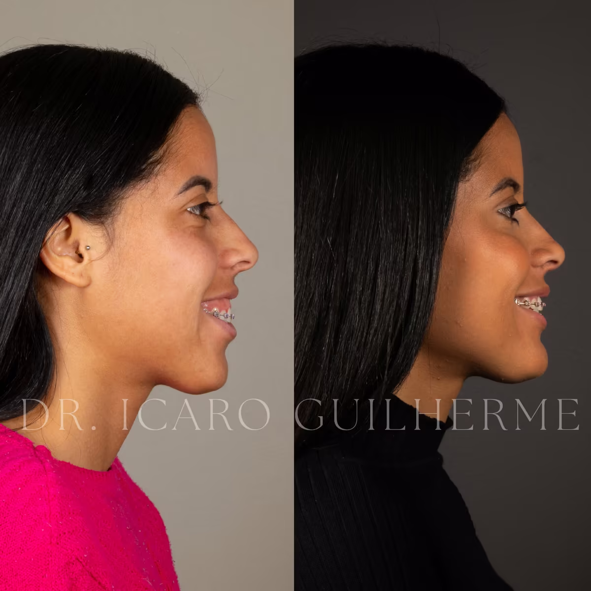 Antes e depois de correção de sorriso gengival — vista de perfil sorrindo, segundo caso