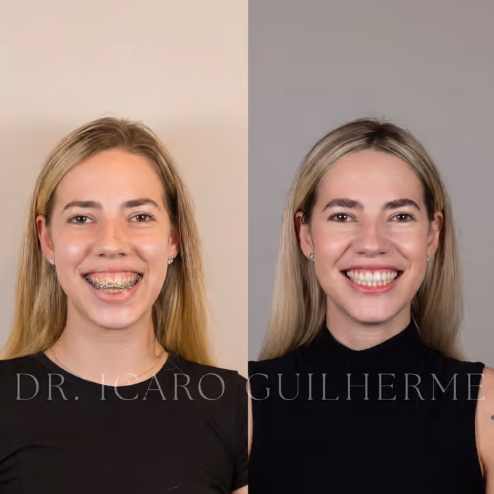 Antes e depois de correção de sorriso gengival — vista frontal sorrindo